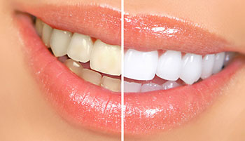 cosmetic-dentist-before-after